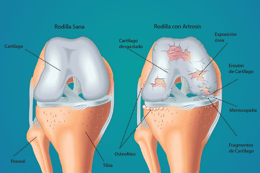 Artrosis de rodilla