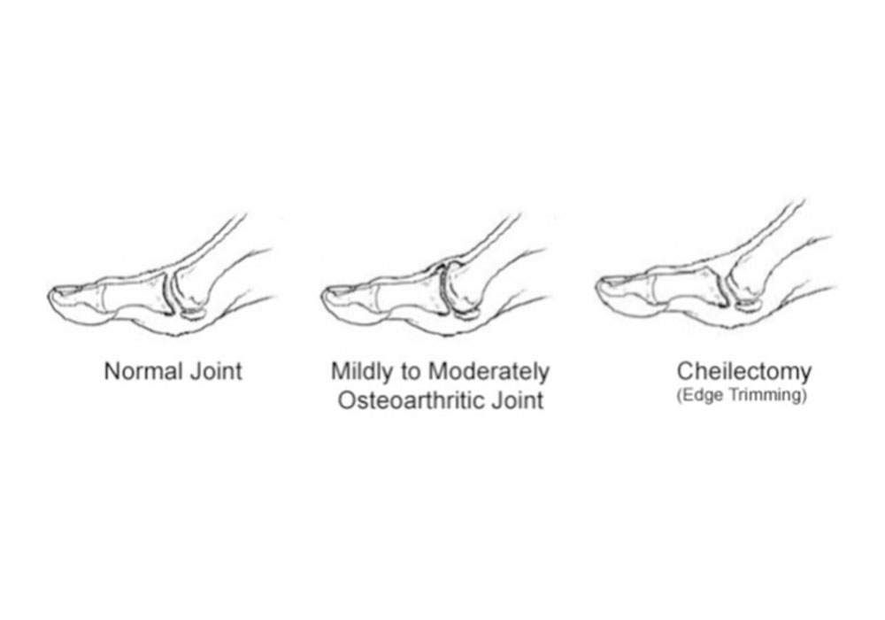 Hallux Rigidus (Cheilectomía - Recorte de los bordes óseos)