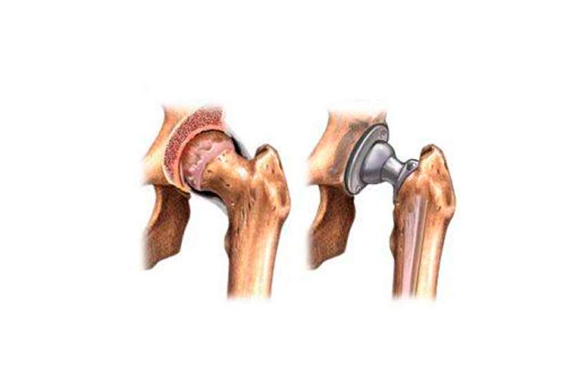 Artrosis de Rodilla - Orthotrauma Perú