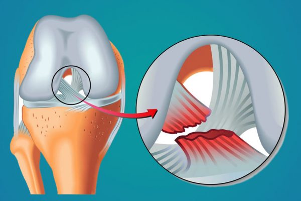 Rotura De Ligamento Cruzado Anterior Lca Orthotrauma Per